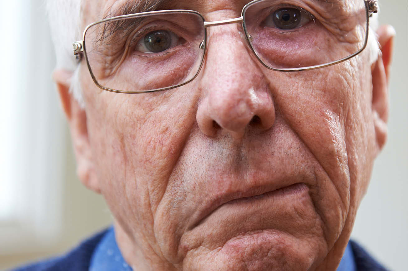 En eldre mann med halve ansiktet hengende nedover med hjerneslag